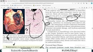 Chp#11 Robbins Patho | Heart Pathology | Heart Effects of Non Cardiac TUmours | Carcinoid Heart